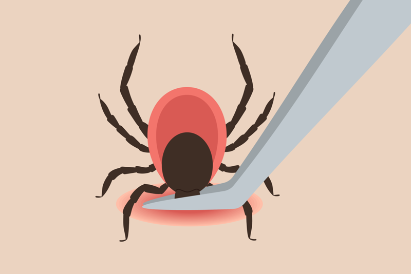 illustrasjon av flått som biter i huden og tas bort av en klype
