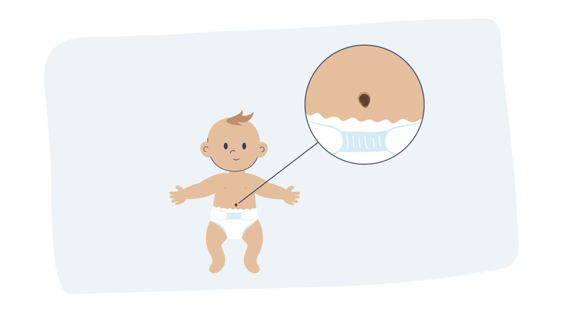Bilde av animert baby med navlegranulom.