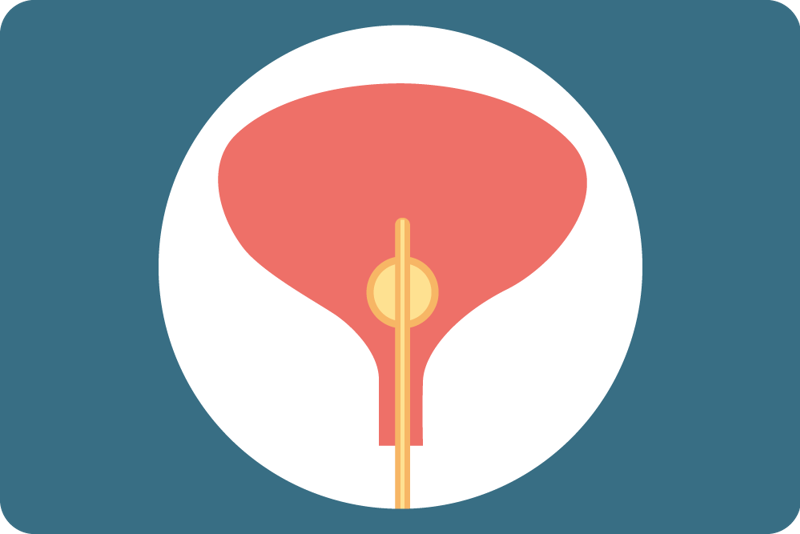 Illustrasjon av kateter