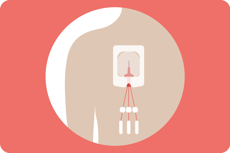 kropp som får lagt inn et intravaskulært kateter