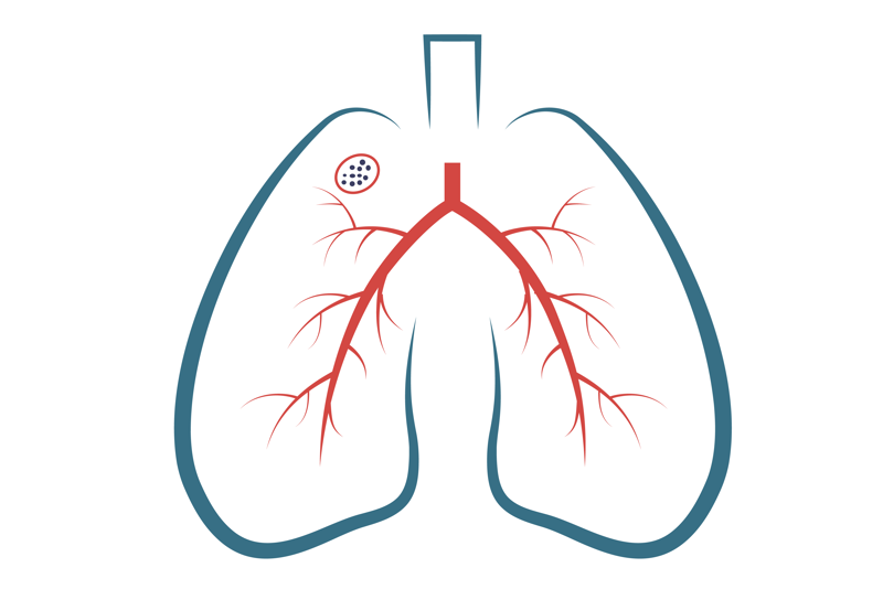 Lunger med tuberkulose - illustrasjon