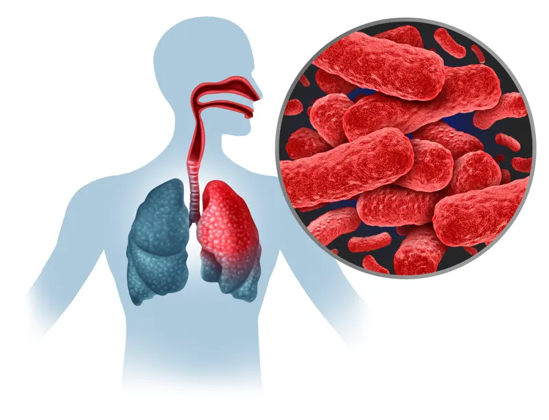 illustrasjon av person med tuberkulose