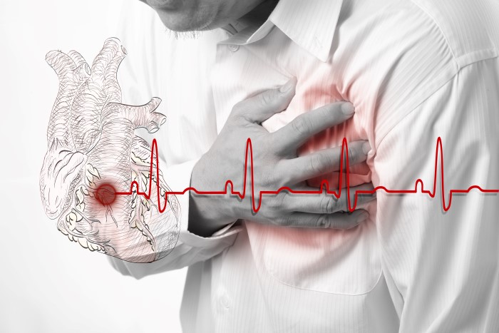 illustrasjon hjerteinfarkt 