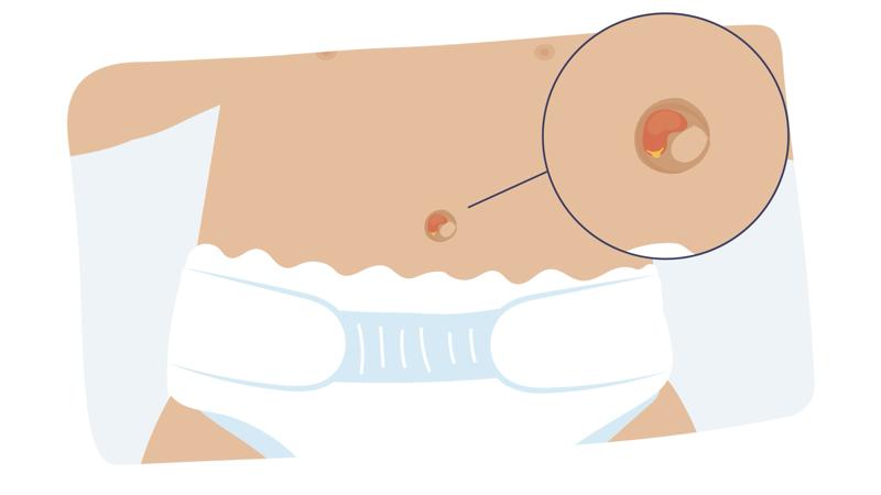 Illustrasjon av navlegranulom hos spedbarn