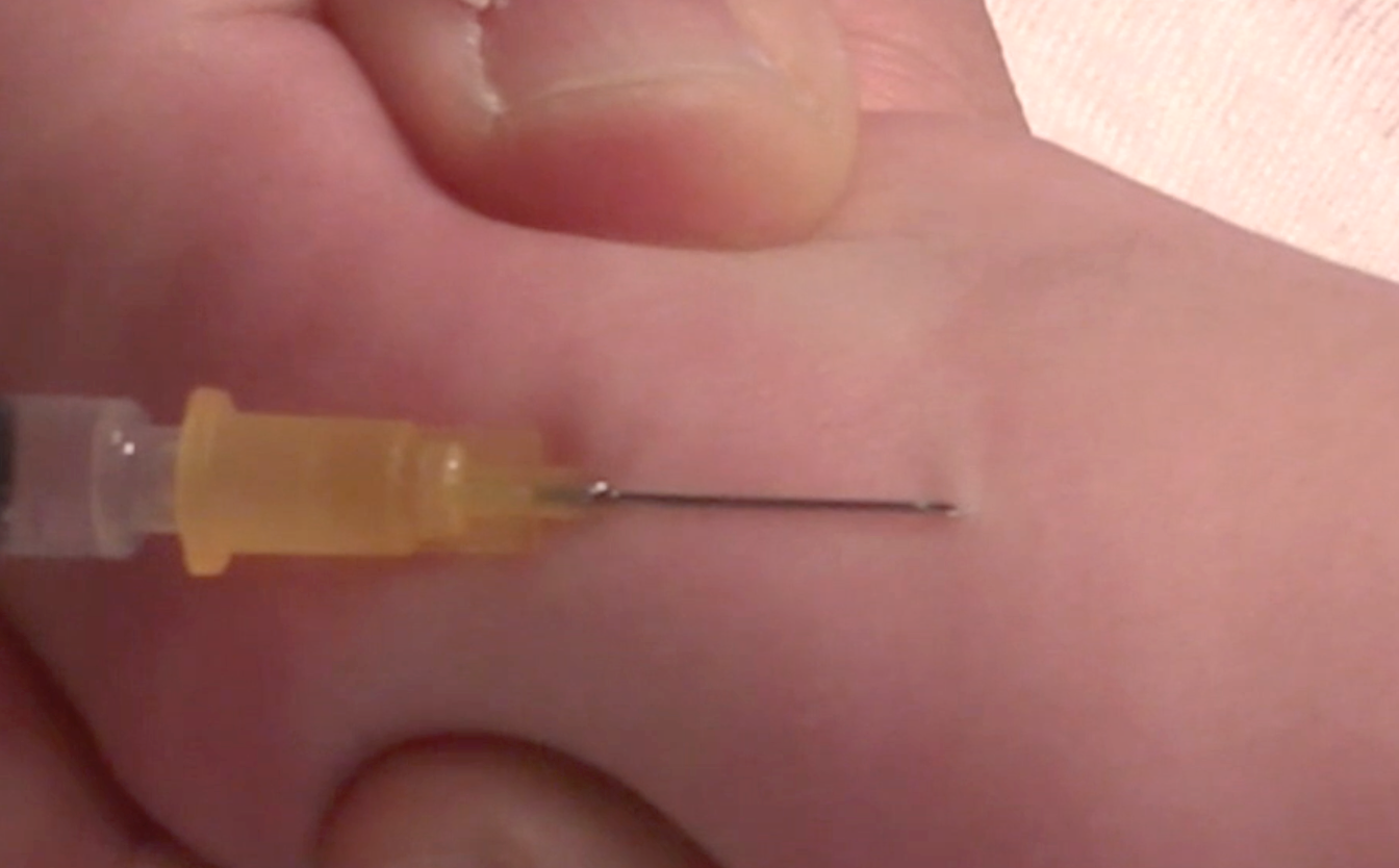 bilde av hvordan nålen skal legges ved intradermal injeksjonsteknikk
