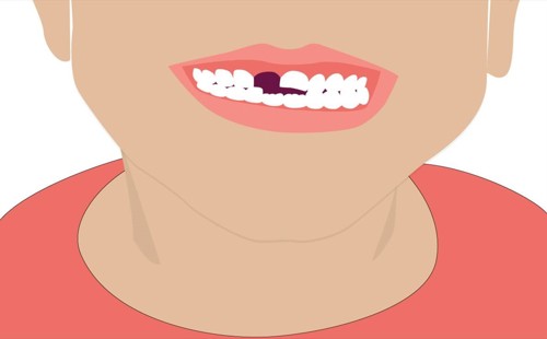 Illustrasjon av barn med manglende tann/missing tooth