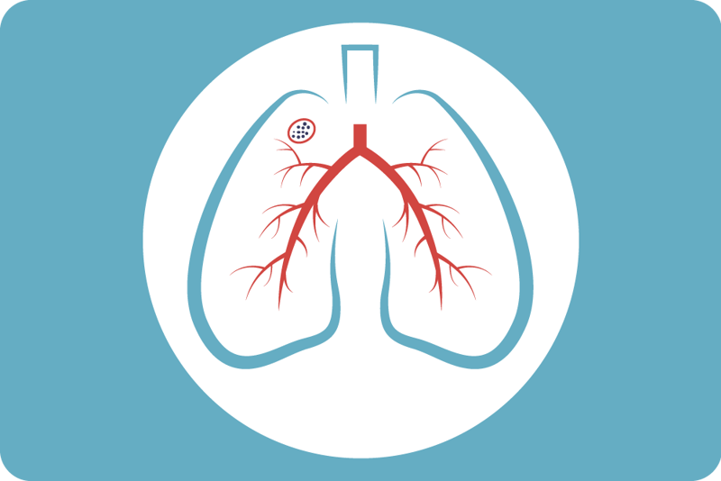 Illustrasjon av tuberkulose på lunger