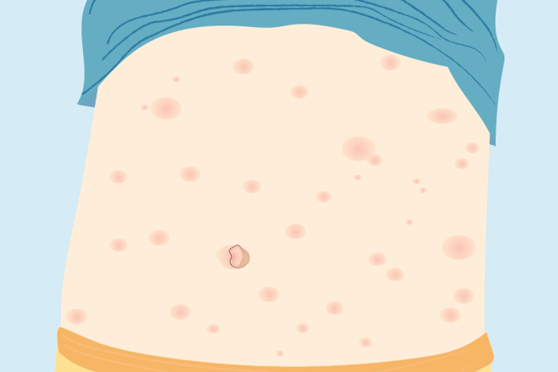 illustrasjon svømmekløe