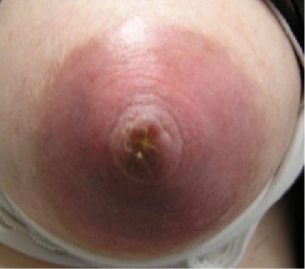 bilde av brystknopp med soppinfeksjon