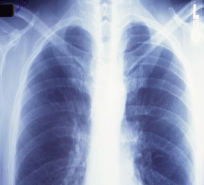 Illustrasjon lungerøntgen