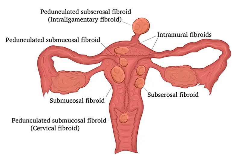 Illustrasjon av livmorknuter