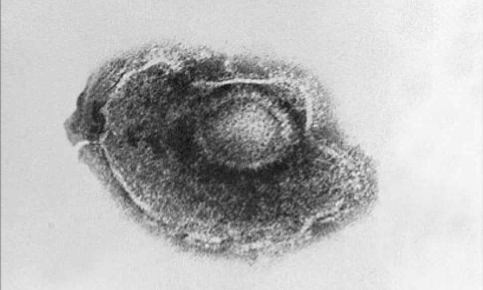 Varicella zoster-virus (foto)
