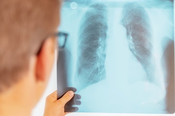 person som ser på røntgenbilde av lunger