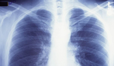 tuberkulose lunger smal.jpg