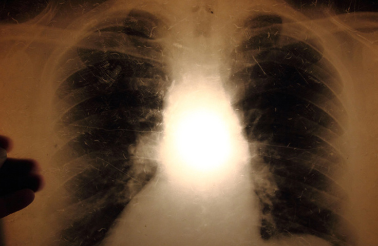 tuberkuloseveilederen lunger.jpg